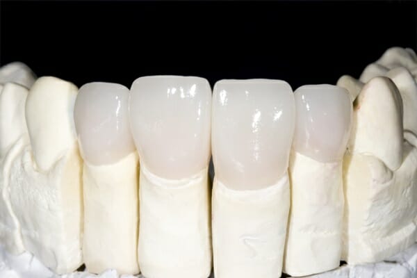 Răng sứ Cercon HT
